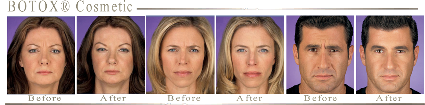 Before-and-After-Botox-Cosmetic-Treatments